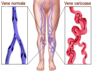 tratament-varice